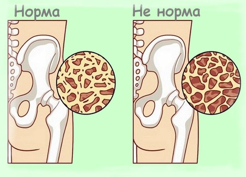 Укрепление костей после 55: советы для активной жизни