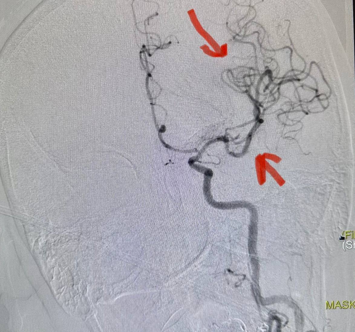 Специалисты регионального сосудистого центра БСМП №1 поставили на ноги 39-летнюю пациентку, перенесшую острый инсульт Специалисты регионального сосудистого центра БСМП №1 поставили на ноги 39-летнюю пациентку, перенесшую острый инсульт