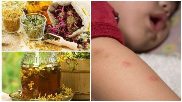 Как справиться с зудом: народные средства от укусов комаров и мошек